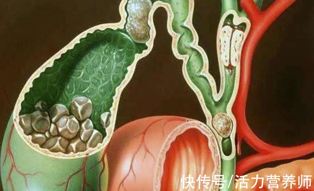 烟熏肉|美国哈佛大学最新研究：我国结直肠癌多是吃出来的，远离3种食物