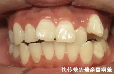 乳牙|家长必读权威专家提醒：必须在12岁前处理的10种儿童牙颌畸形
