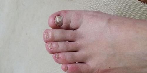 出血脂|血脂高不高,”小腿“先知?医生:血脂偏高,身体或有这几个表现