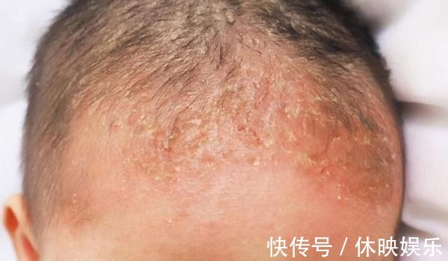 皮肤病|发现新生儿小屁屁上有“淤青”,老公想找护士理论,最后暗暗庆幸