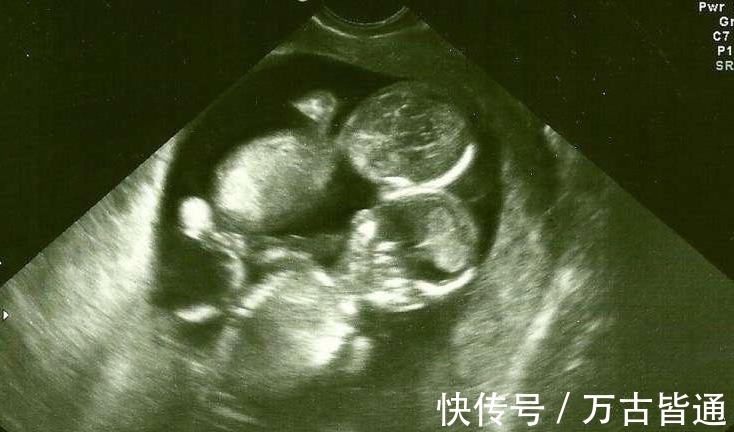 医生|做产检发现怀的是连体婴却仍要生,结果小孩出生那一刻所有人都!