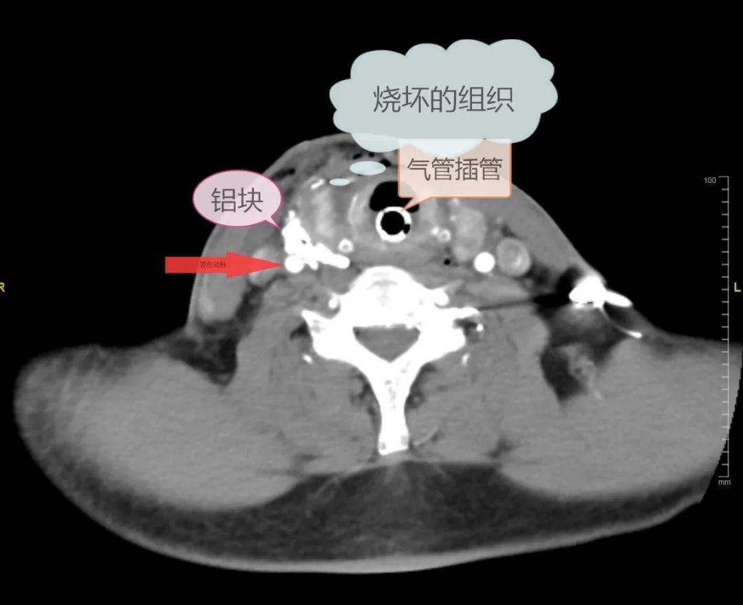 血管|660℃铝液喷溅,一男子颈总动脉中招!剥离出50多块铝块