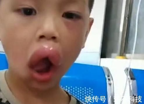 小男孩|熊孩子偷吃了一颗葡萄，嘴巴变成了香肠嘴，医生看了都憋笑