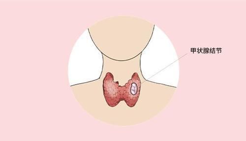 有了甲状腺结节,别失落,少吃三种蔬菜,也有恢复可能