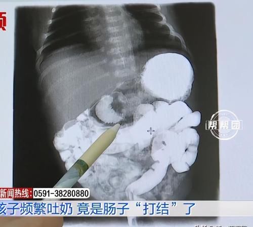 频繁|这些症状的吐奶需警惕！新生儿频繁吐奶，险丧命