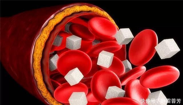 糖分|高血脂的人日常需要有哪些忌口?专家提醒:这3种食物需要注意