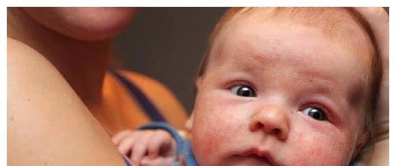 婴儿|冬季天气干冷,宝宝容易爆发湿疹?可能只是父母这三件小事没做对