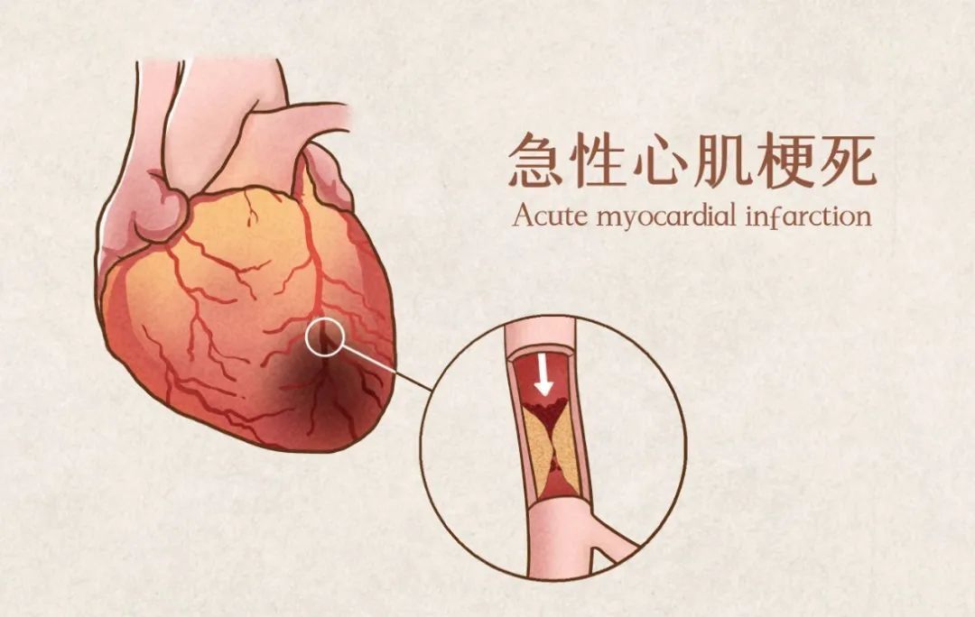 心梗|博士健康课丨天冷心梗高发！胸痛无小事，千万不要忍