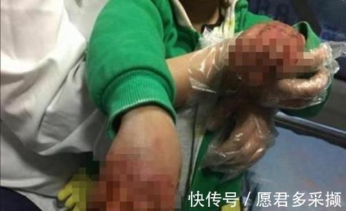 医生|4岁男孩掉进180度油锅,奶奶神操作救了孩子,医生:模范操作