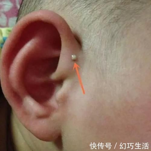 宝妈|为啥有些新生儿耳朵有小孔?医生一般不会主动讲,家长心里要有数