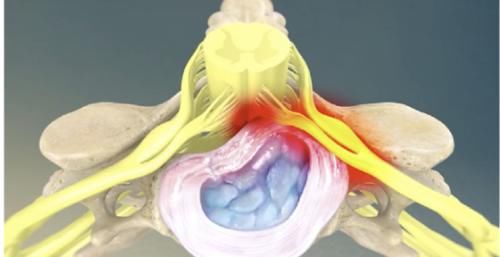 头晕头痛|头晕头痛？脖子酸痛？手麻？颈椎病这个“流行”病要注意