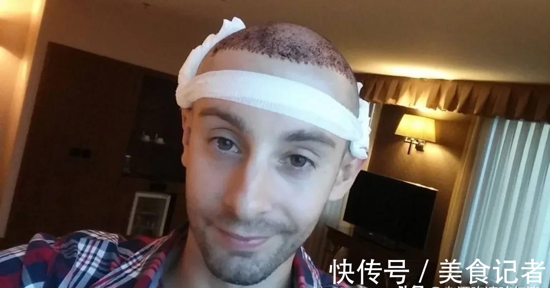 chris 每个月到底有多少人去土耳其植发?