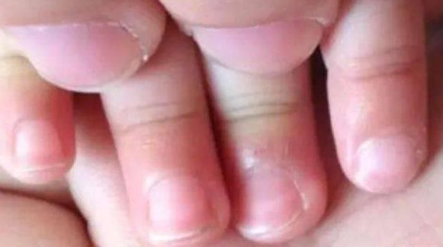 家长|孩子手上经常出现“倒刺”,家长着急,可能是3个原因引起的