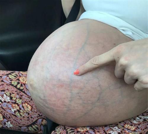 肚子|生完三胞胎后肚子却收不回去，国外宝妈的晒照，诠释伟大母爱