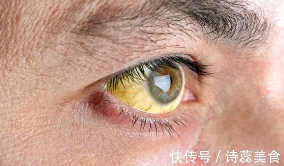 肝功能|肝不好的人，头部会有3处“发黄”，若没有，你就偷着乐吧！