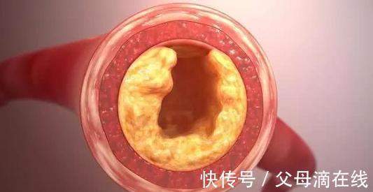 食物|72岁大爷降血脂30年,医生:2种食物是血脂“净化器”,可多吃