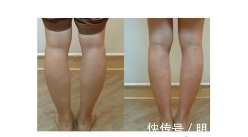 大腿|大腿粗该如何减掉呢？掌握5个瘦腿小方法，让大象腿慢慢变成大长腿！