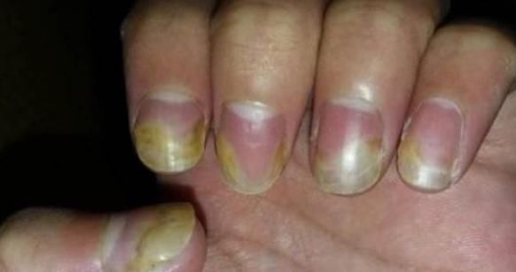 信号|肝出事手知道,手上若出现3个“信号”,或许是肝癌在敲门!