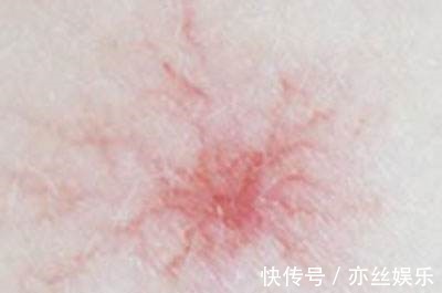 皮肤溃疡|身体2处“发痒”,别误以为是过敏了,或是肝脏癌变发出的求救信