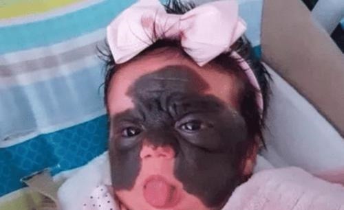 孕期|那个脸上有“蝙蝠”胎记的女孩,如今生活的怎么样?看完很欣慰