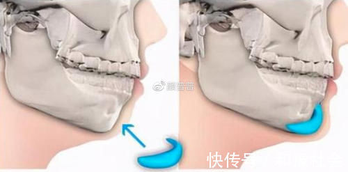 成形术|颏成型术和假体垫下巴有啥区别？下巴短还后缩做哪个好？