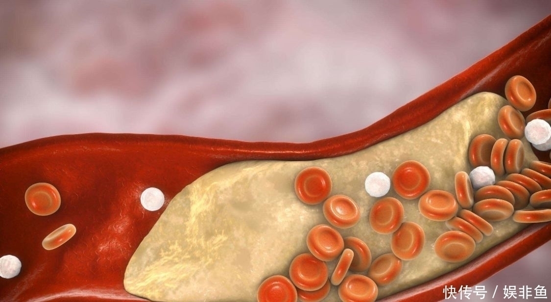 高血脂|生活中,除了大鱼大肉,这2物是高血脂的根源,记得不要贪吃