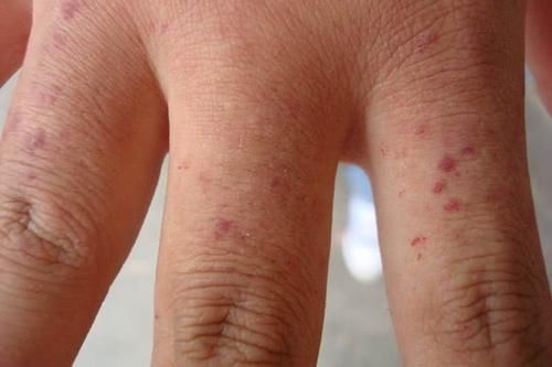 结节在肺部“潜伏”时,或有三个表现,发现一个,及时去查一下