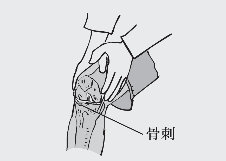 关节|如何才能把骨刺消掉？