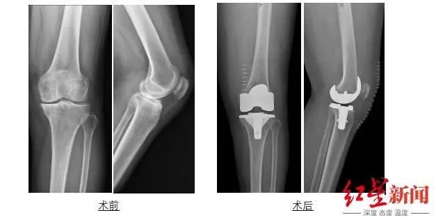 骨关节炎|世界首例!华西医院3D打印人工膝关节植入成功!