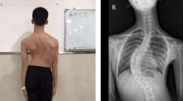 父母|8岁男孩脊椎侧弯,只因家人常做这个动作,这个错误,90%的父母都在犯