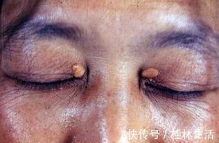 肥肉|血脂高都是肥肉造成的医生不是！这3物才是血脂的“加速器”