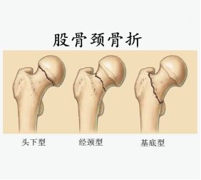 一位92岁高龄老人股骨颈骨折后的康复历程 快资讯
