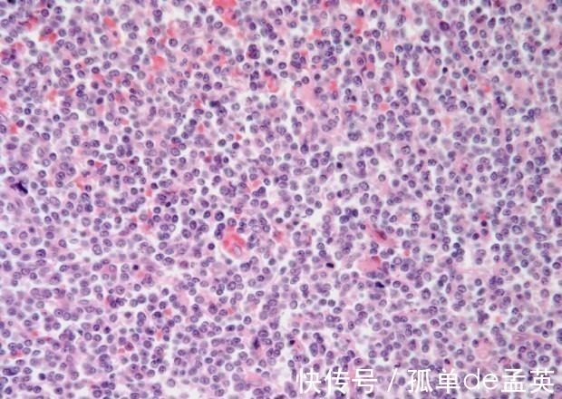 淋巴细胞|血常规，能不能检查出癌症提醒4个指标有异常，要做详细检查