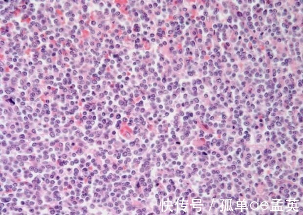 淋巴细胞|血常规,能不能检查出癌症提醒4个指标有异常,要做详细检查