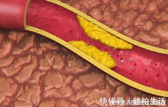 血脂|高血脂害怕2件事,不是山楂,你若能坚持做,血管垃圾一扫而空