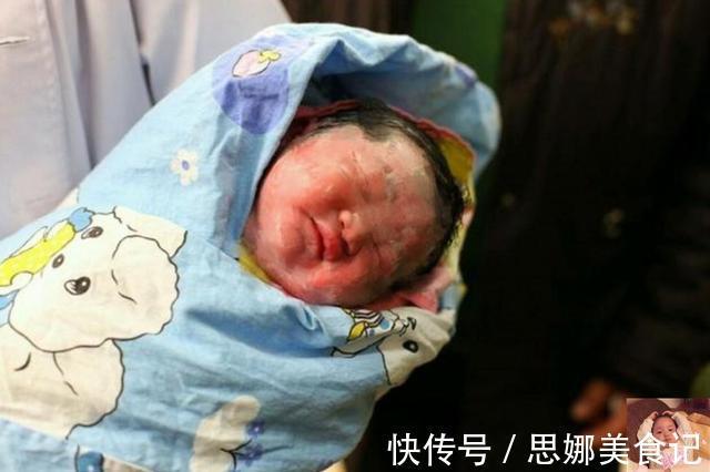 小雪人|妻子生下“小雪人”宝宝,陪产丈夫看到后连忙解释:和我没关系