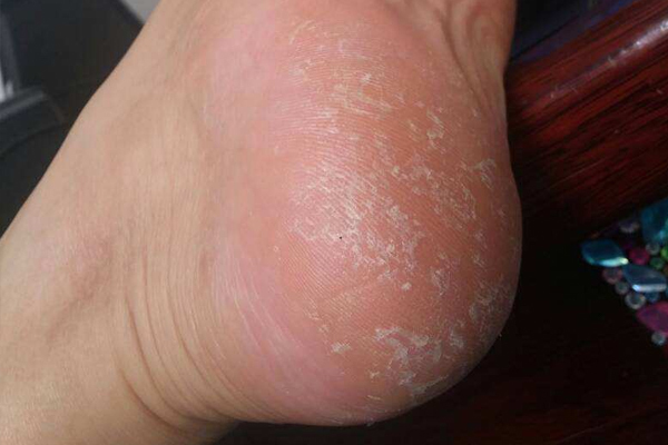 妙招|脚后跟死皮多,又硬又黄,怎么办学会妙招,轻松恢复细嫩双脚