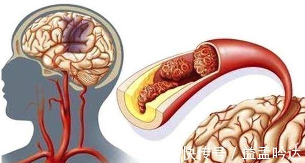 血液|身体出现这个信号，说明中风先兆，多喝一物，血管变干净