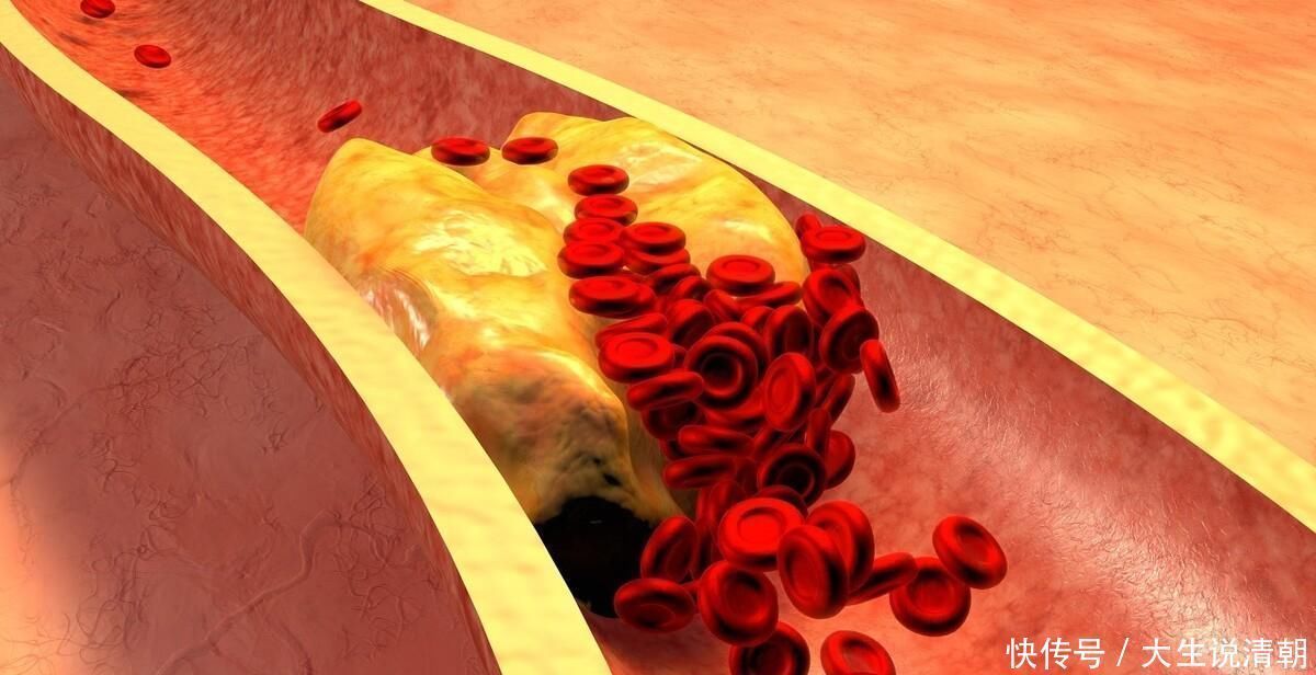 徐奶奶|86岁老人甘油三酯12,血管干净无淤,“诀窍”在于常吃这3物