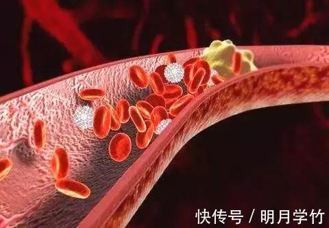 疾病|这5个“暗号”是脑血栓前兆,医生提醒早上尤其要注意“防栓”