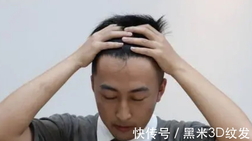 效果好 黑米3D纹发:关于植发的一些事实《9-11》