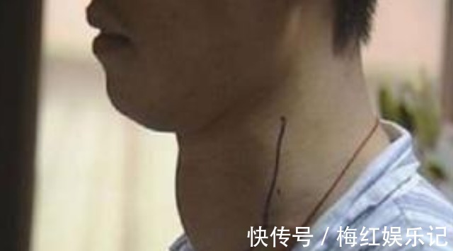 吞咽困难|三种发物,吃得越多,甲状腺结节越大?医生提醒:控制自己