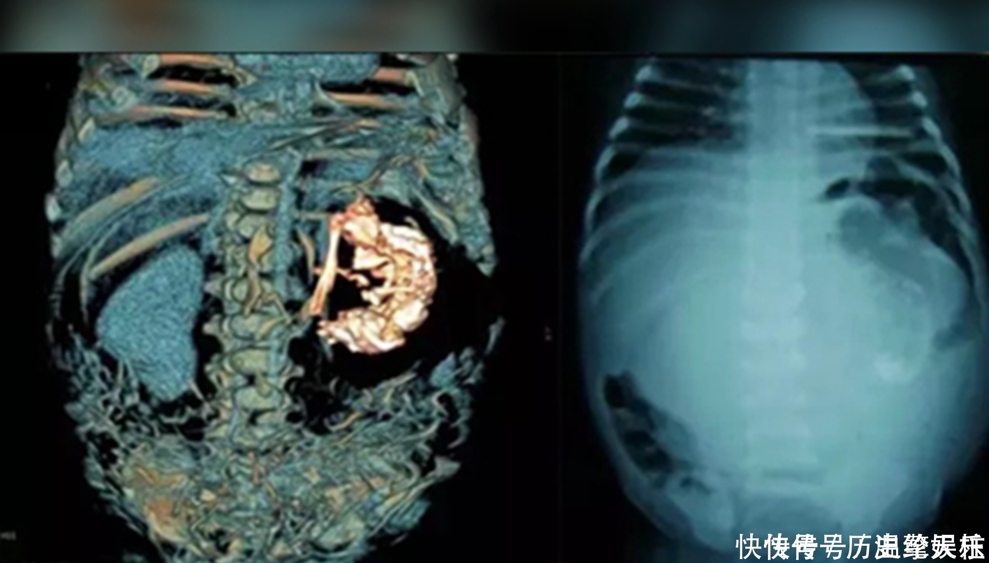 生育|史上最小产妇非寄生胎,5岁产子打破生育极限,儿子称她“姐姐”