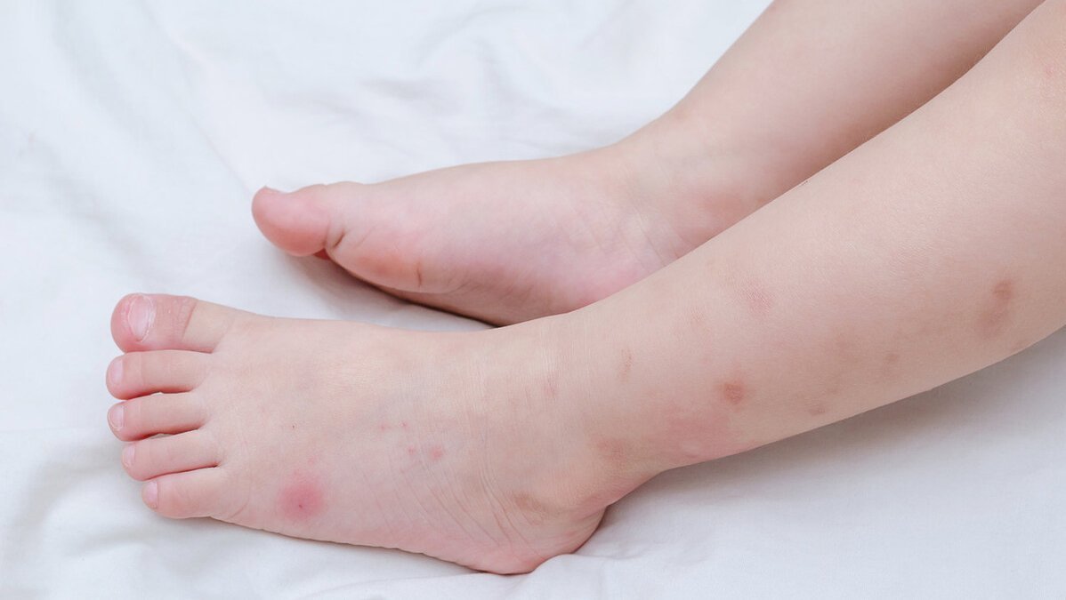 酸性|夏天被蚊子扰得不厌其烦?医生教你科学方法,轻松让蚊虫去咬别人