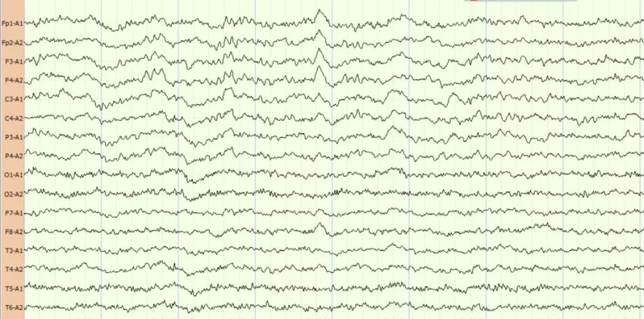 心跳骤停|医生,我爸还能醒吗?会不会变成植物人?