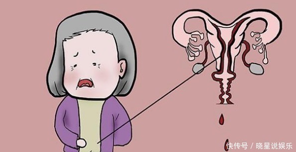把流产当月经险些送命,更年期需不需要避孕