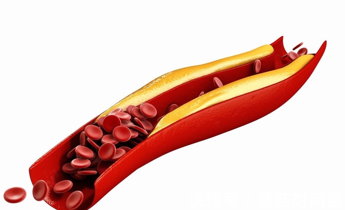 低密度脂蛋白胆固醇|高血脂的“天敌”是什么?本文带你详细了解