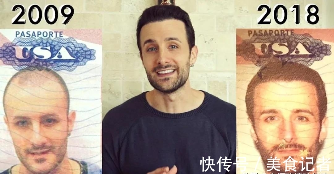 chris 每个月到底有多少人去土耳其植发?