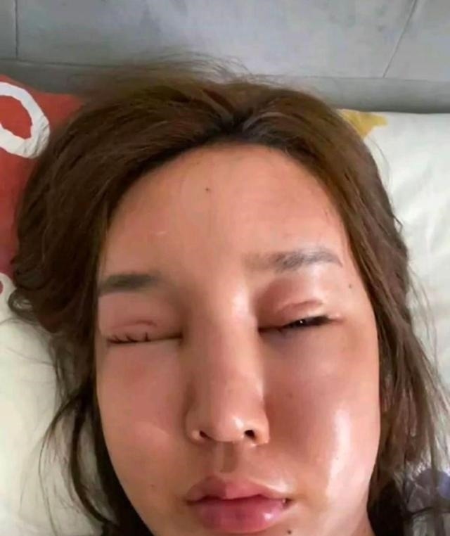光额头 8年的整形手术花费了100多万,光额头就打了200多支玻尿酸
