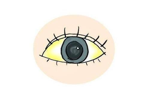 棕黄色|眼睛出现这些表现，说明你的肝脏出问题了，还请及时去医院检查！